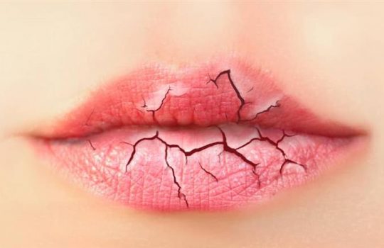 Cara Mengatasi Bibir Kering dan Pecah pecah Dengan Bahan Alami